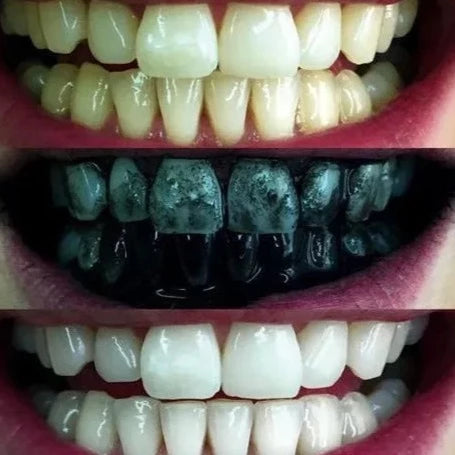 Blanqueador Dental 100% Natural - (apto para dientes sensibles)